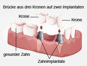 Anerkannte Zahnklinik Zahnarzt im Ausland Polen Stettin bietet preiswerte kostengünstige Zahnersatz Zahnimplantate Zahnkronen Zahnbrücken Zahnprothesen an