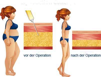 Fettabsaugung Liposuktion Stettin Polen Ausland Liposuction Dmytrzak Aesthetic Med Schönheitsklinik Schönheitschirurgie OP's Schönheitschirurg