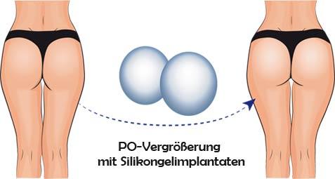 po-vergrößerung-implantate-gesaess-kosten-polen-BBL brazilian but lift stettin-polen ausland aesthetic med dmytrzak schönheitsklinik po vergrößerung eigenfett implantate polifting gesäß operation chirurg schönheitsoperation schönheitsklinik